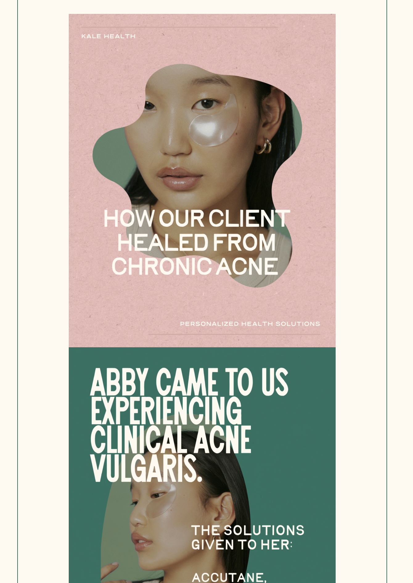 Kale Health email campaign featuring a client's acne care story